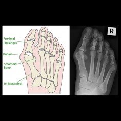 Bunion Anatomy